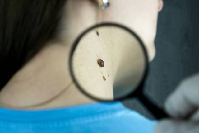 ALERT: HSE warn beauty treatment can increase skin cancer chances by 75%