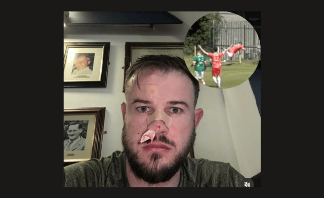 Instagram star suffers nasty injury during charity match