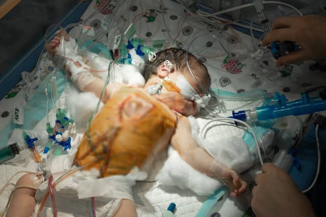 Baby Khrystina in recovery from surgery