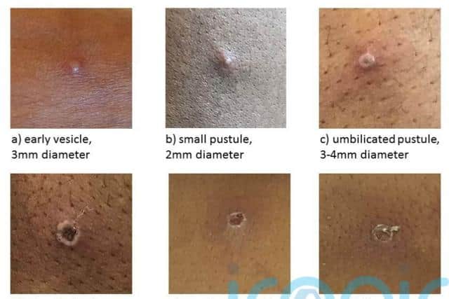 He made the comments after health officials in Northern Ireland confirmed yesterday (Thursday May 27) that a case of monkeypox has been identified in the region.