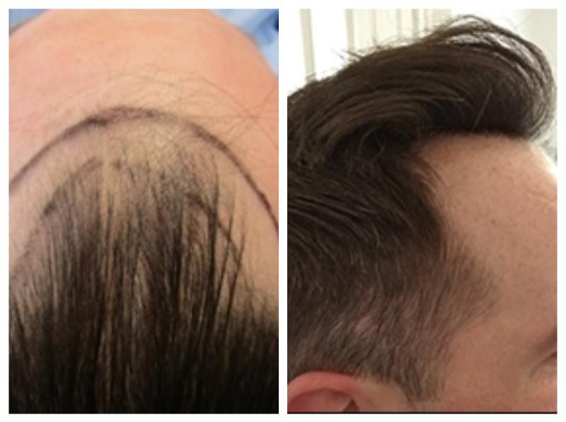 Tipperary man shares mind-blowing hair transplant transformation 