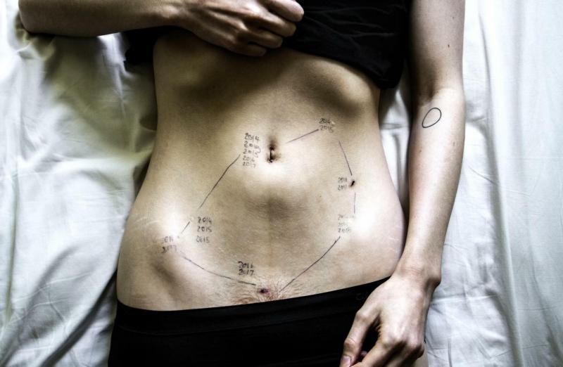 Explainer: What is endometriosis? A debilitating condition that is often dismissed
