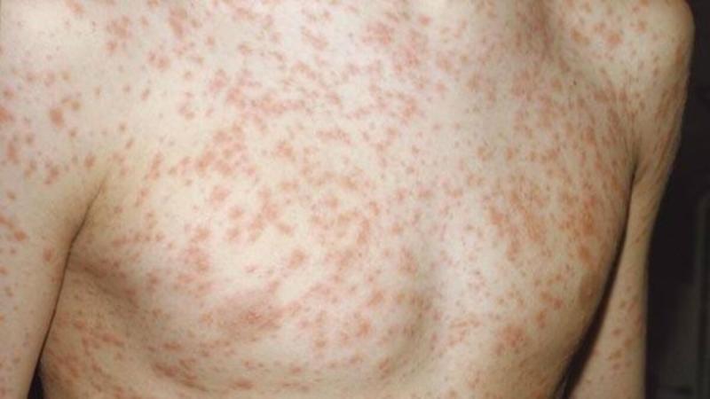 Measles: HSE urges Dublin flight passengers to come forward after third case confirmed in Ireland