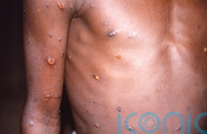 HSE widening rollout of monkeypox vaccine to people in Waterford at high risk